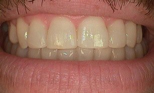 corrected misaligned teeth