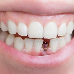 person smiling with a dental implant abutment