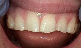 chipped tooth