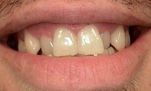 Misaligned teeth