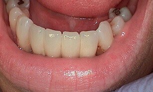 replacement teeth after