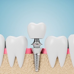 an illustration of the parts of dental implants in Concord, NH