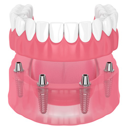 Illustration of implant dentures in Concord, NH using four dental implant posts