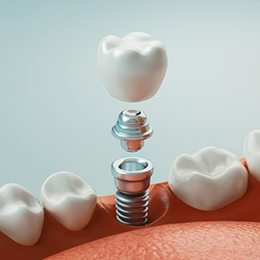 dental implant being placed into the lower jaw