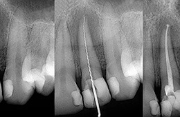 x-ray of root canal