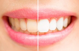 A before and after of a patient’s smile after undergoing teeth whitening.