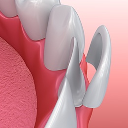 3D render of veneers