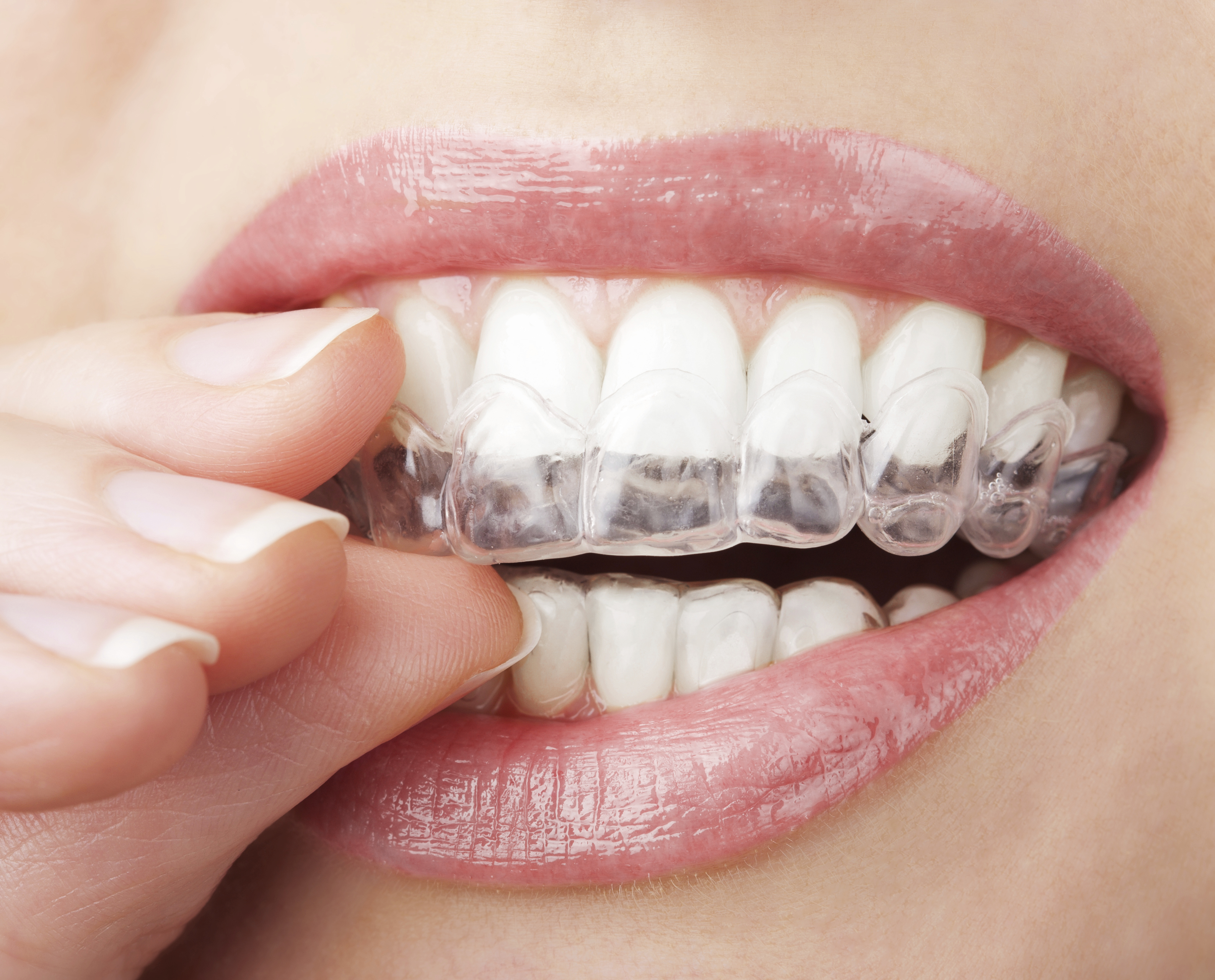 Invisalign  Route 9 Dental