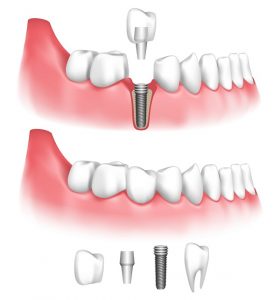 Dental implants in Concord restore oral function and looks after tooth loss. Read how these innovative prosthetics work at Generations Dental Care.