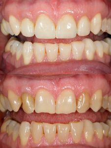 Have gaps, crooked, or crowded teeth and want to makeover your grin? Your cosmetic dentist in Concord can give you the winning smile you deserve. 