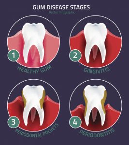 Are you unsure of what to do about your bleeding gums? See your dentist in Concord to treat and prevent worsening gum disease. 