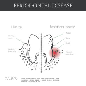 Generations Dental Care, your trusted dentist in Concord, can keep your smile healthy with treatment for gum disease. 