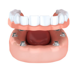 With dental implants in Concord from Generations Dental Care, you can restore your smile to its former glory. 