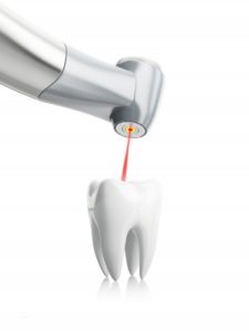 An illustration of laser dentistry.
