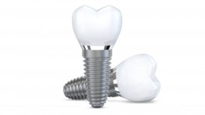 a replica of dental implants to be placed in place of front teeth